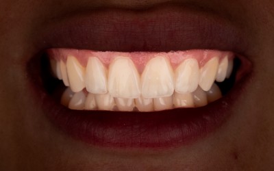 - Direktne kompozitne fasete -  Dr Nevena Stanimirov - 04.04.2026